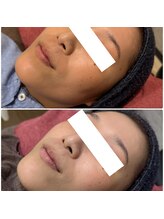 カンフリエ 吉野ヶ里店(Camphrier)/ハーブピーリング