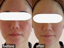 ルナステラ 七尾店/ヒト幹細胞エイジングケア