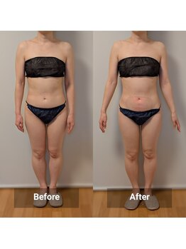 リノリー 一関店(rinory)/脂肪冷却