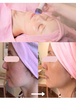エステティックサロン アールグレーの写真/小顔ならコレ！幅広い世代に大人気★ハイパーナイフ美小顔フェイシャル