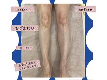 ポーラ ザ ビューティ 小倉駅前店(POLA THE BEAUTY)/フットケアbefore after