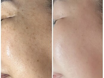 アンヘル(Angel)/ハーブトリートメント