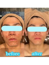 クラッシーガール ダンディエール(QlassyGirl DANDYELL)/【30代】10回後/ピーリング