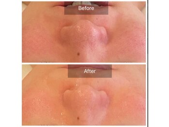 ベンザイ 梅田店(BENZAI)/毛穴、肌荒れ、乾燥