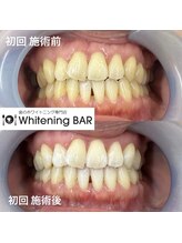 ホワイトニングバー 大宮店/初回のビフォーアフター