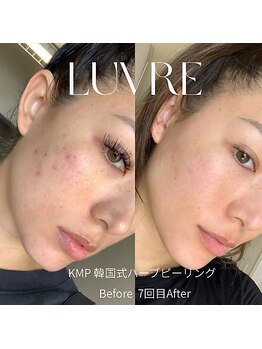 ルーヴレ(LUVRE)/KMPハーブピーリング