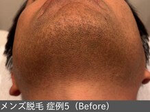 オアシスラグーン(OASIS LAGOON)/メンズ脱毛（症例5 before）