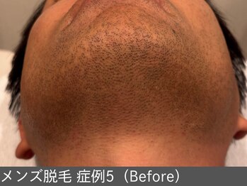 オアシスラグーン(OASIS LAGOON)/メンズ脱毛(症例5 before)