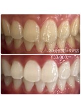 ホワイトニングルーム 横浜店(Whitening Room)/セルフホワイトニング/横浜