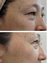 ジオリッチシフォン(giorich chiffon)/フォトジェニック2周1回シミケア