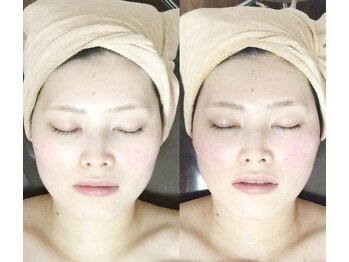 メディカルサロン かとれあ/スーパーリフト術