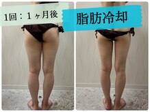 ソルニス(Solnis.)/痩身☆脂肪分解/ハイパーナイフ