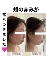 ブルーシー(BLUESEA)/【RHR】幹細胞ハーブピーリング