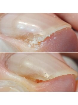 爪切り屋 足楽/痛い爪◆爪溝鶏眼