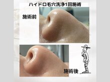 おにぎり(ONIGIRI)の雰囲気（#毛穴洗浄 #水光肌 #ハイドロヴィーナス #敏感肌 #黒ずみ#韓国肌）