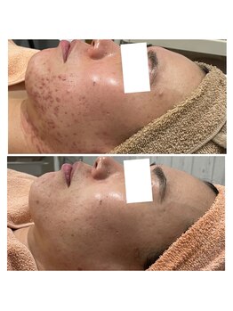 リッツ 所沢店/【Before/After】ニキビケア