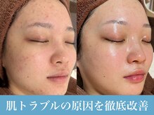 ミュー(mieux)の雰囲気（ハーブピーリングで赤みや毛穴、ニキビケア自分史上最高肌に）