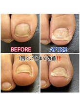 キラキラフット神領 ありが接骨院/巻き爪/フットケア