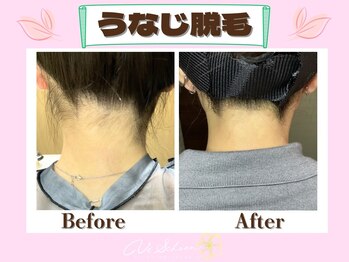 ヴィ シェーン(Vi Schoen)/うなじBefore/After 【W型】