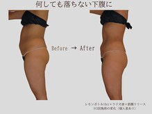 プレリー 自由が丘店/落ちない下腹に