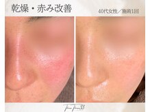 スリースリー 恵比寿(THREE THREE)/乾燥・赤みケア
