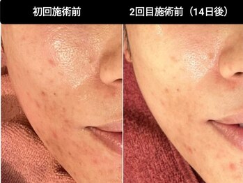 ベリッセ(Belisse)の写真/【ニキビ集中15,000～】ニキビ・肌荒れ集中ケアで素肌に自信を。プラズマで鎮静ケアを叶えるエステサロン☆