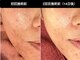 ベリッセ(Belisse)の写真/【ニキビ集中15,000～】ニキビ・肌荒れ集中ケアで素肌に自信を。プラズマで鎮静ケアを叶えるエステサロン☆