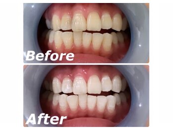 サロン シェリミー(Cheri mi)/セルフホワイトニング