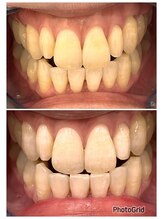 ティンクルホワイト 橿原店/輝く白い歯に！！