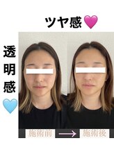 ブルーシー(BLUESEA)/【RHR】幹細胞ハーブピーリング