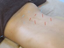 按鍼道/腰はり3