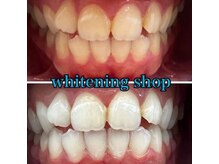 ホワイトニングショップ 長岡京店/ホワイトニングビフォーアフター