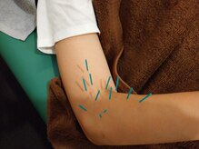 上野毛駅前整骨院 鍼灸院/肘への鍼