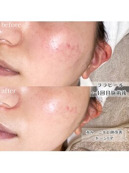 ソワ(soie.)/【韓国肌管理】ララピール