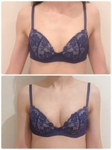 リール 新宿店(RIRE)/30代前半　バストアップ症例