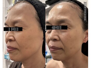 ウォーム(Warm)/60代　マイクロニードル施術例