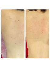 ティエット(tiet)/背中のハーブピーリング