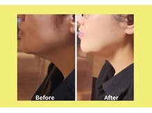 アン 銀座(ann)/あごラインスッキリ