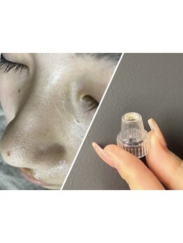 毛穴ケアをしたい