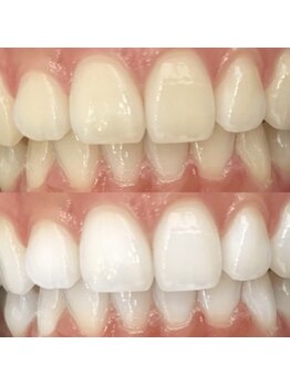 ホワイトニングセンター うるま江洲店/沖縄市・うるま市ホワイトニング