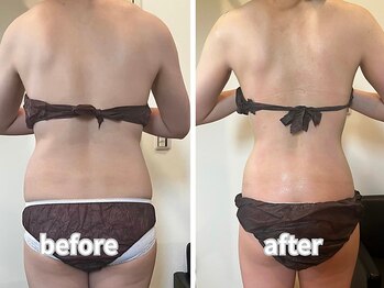 エミニーライフ(EMINY LIFE)/ブライダルエステ☆