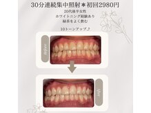 プラスビーセルフ(+b self)/ホワイトニングビフォーアフター