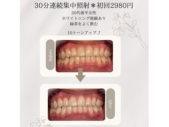 プラスビーセルフ(+b self)/ホワイトニングビフォーアフター