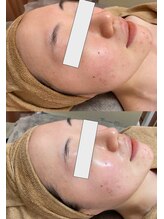 チャヨン/幹細胞ピーリング1回の効果