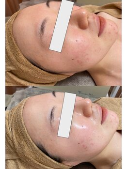 チャヨン/幹細胞ピーリング1回の効果