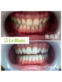 ルブラン 奈良店(Le Blanc)/写真でも映える歯に♪