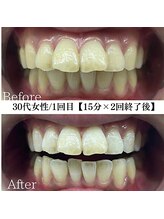 ホワイト 福岡博多店(WHITE)/ホワイトニングビフォーアフター