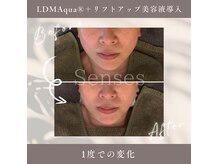 センシズ(Senses)の雰囲気(痛み・ダウンタイムなし!理想のVラインで小顔に自信♪)