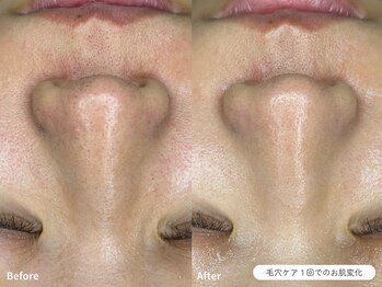 フォンビューティー(fon beauty)/毛穴ケア1回