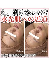 ホワイトアクア 天王寺本店(WHITE AQUA)/ララピールで肌荒れ改善/天王寺